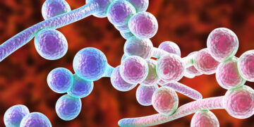 9 Signs Candida Is Wreaking Havoc on Your Body