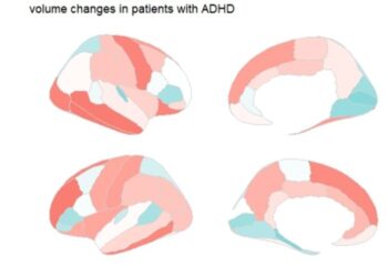Brain Markers of ADHD in Children Identified