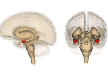 Amygdala connectivity predicts ketamine treatment response among patients with anxious depression