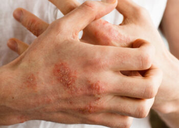 Eczema linked to increased symptom severity in children with autism spectrum disorder