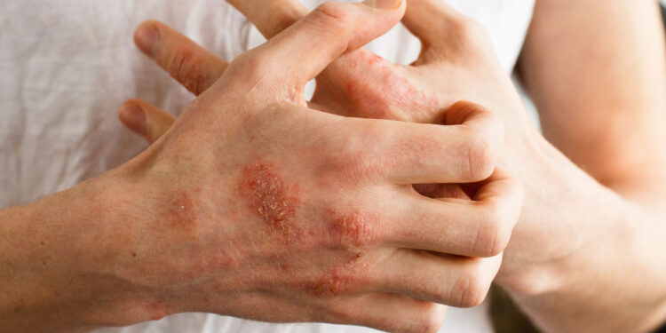Eczema linked to increased symptom severity in children with autism spectrum disorder