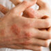 Eczema linked to increased symptom severity in children with autism spectrum disorder