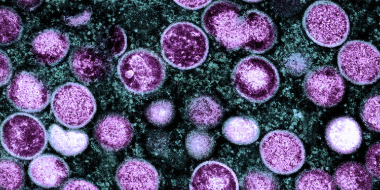 Monkeypox may cause severe neurological complications in a small proportion of infected individuals