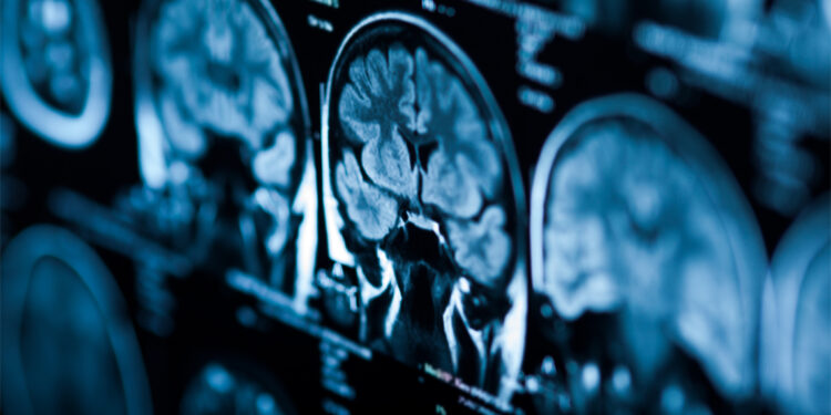 Study links vitamin D deficit to accelerated brain aging