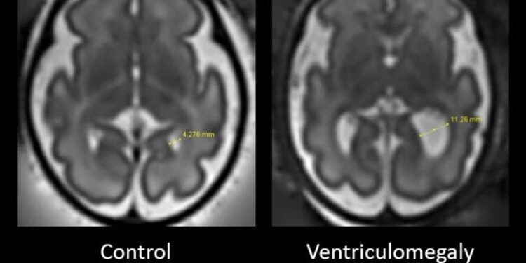Early Indicators of Autism May Be Identified in Fetal Brain Scans