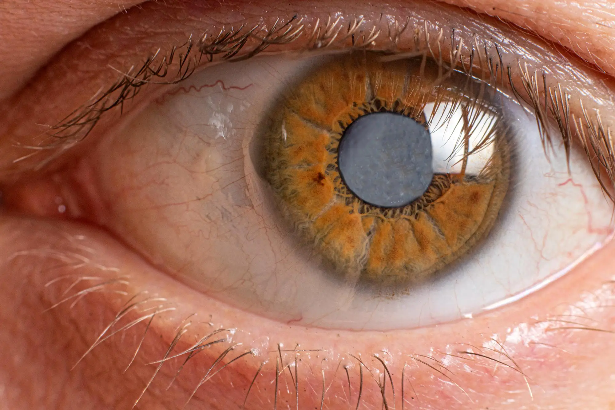 “Sugar Hypothesis” of Diabetic Cataract Development Gets an Eye-Opening Reality Check