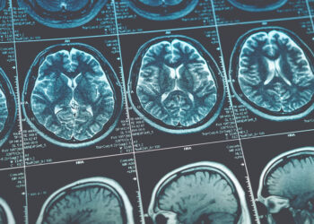 MDMA use in humans is not associated with severe white matter lesions, study finds