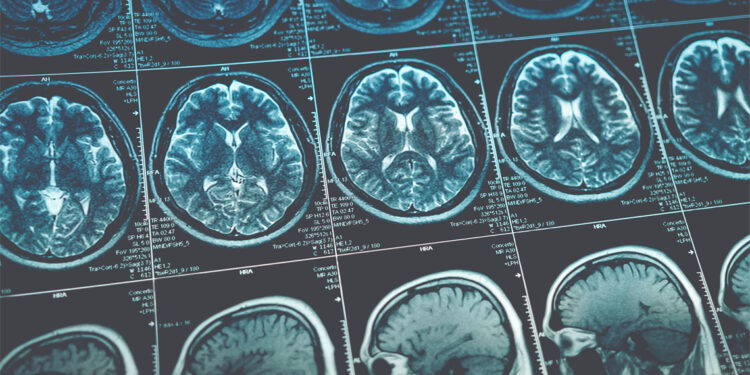 MDMA use in humans is not associated with severe white matter lesions, study finds