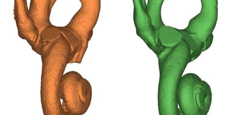 First Neandertal with Down Syndrome: Evidence of Altruistic Care in Prehistory