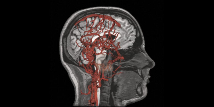 High blood pressure and stiff arteries linked to cognitive issues in adolescents, study finds