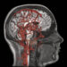 High blood pressure and stiff arteries linked to cognitive issues in adolescents, study finds