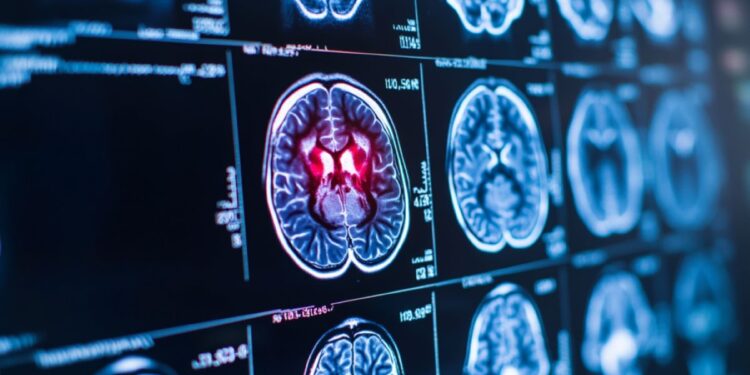 Does Multiple Sclerosis Lower Dementia Risk?