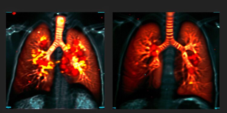 Real-Time Lung Scans Transform Treatment