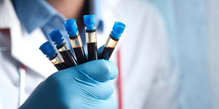 New Study Raises Alarm Over Alzheimer’s Blood Tests